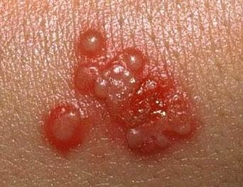 Illustration for article titled Obat penyakit herpes di badan